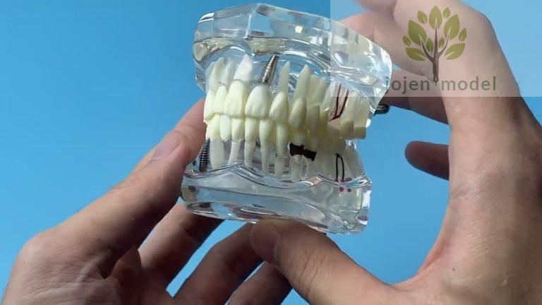 Special Tooth Models High Grade,Dental bridge model High Quality,Oral surgery Model High Grade,