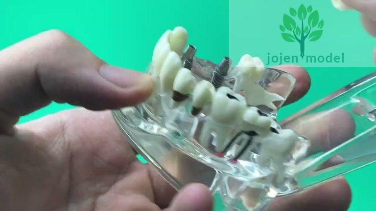 implant model dental,Special Tooth Models affordable,dental education models maker Chinese.