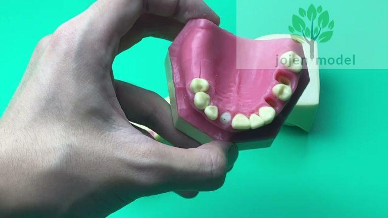 dental implant demonstration models,Educational Model for Implant Denture,Dental Implant Model.