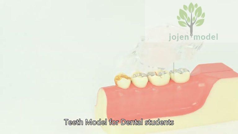 Educational Model for Implant Denture China customize,dental implant training models China Best