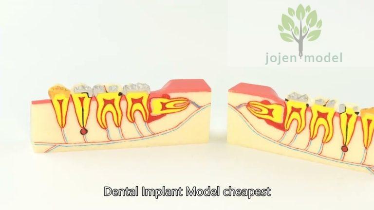 implant model bone China Best Manufacturer,dental implant model study China High Quality Factory,