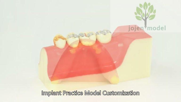 Educational Model for Implant Denture,dental implant practice models China High Quality Supplier,