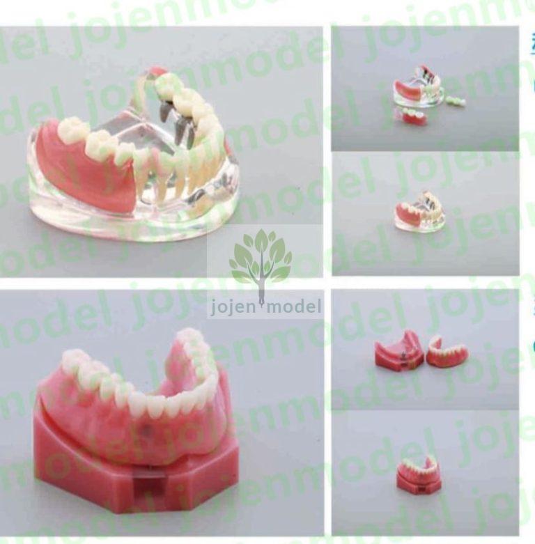 Jojen Model: Your Premier Dental Crown Model Manufacturer